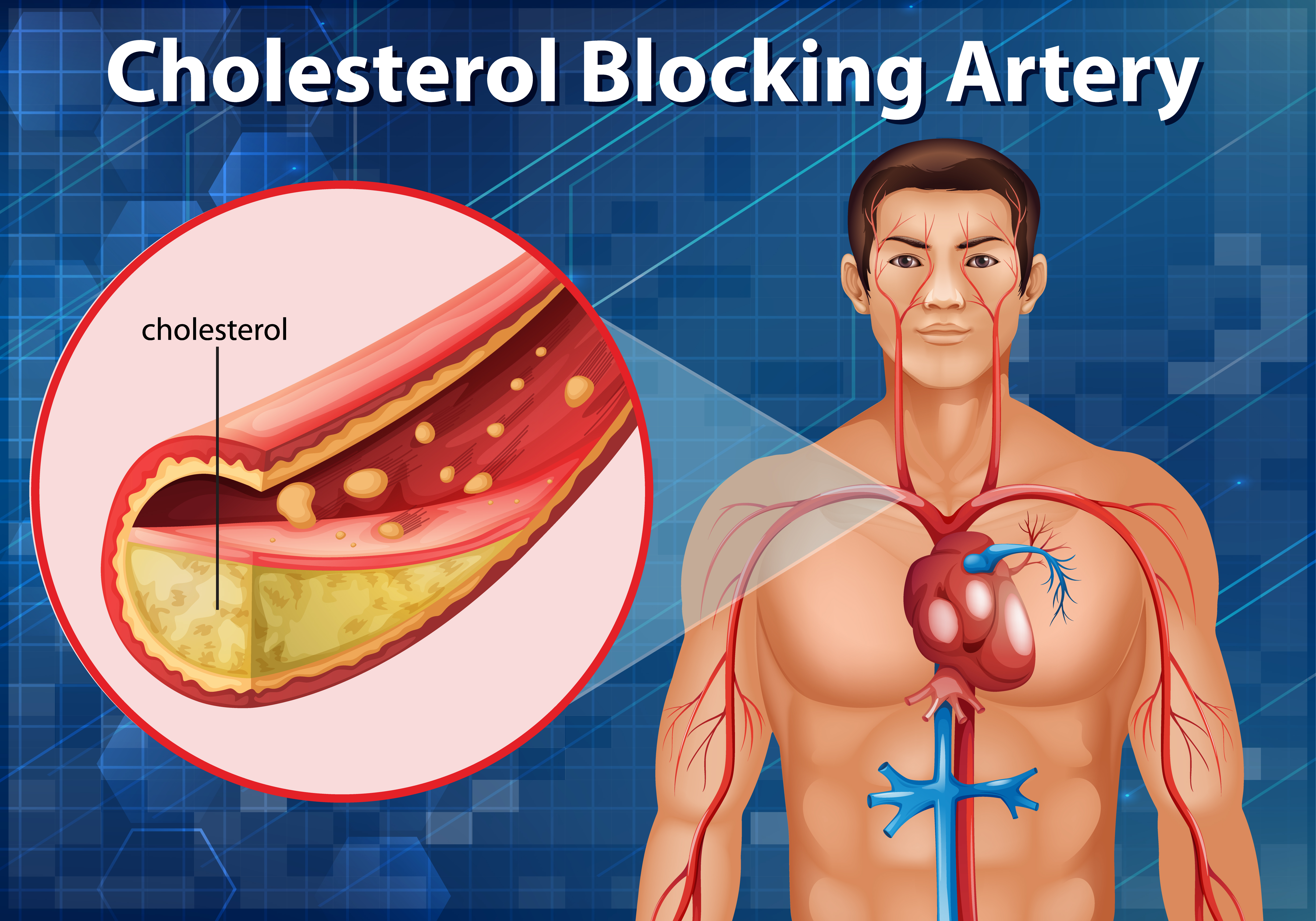 Cholesterol Treatment in Chandigarh